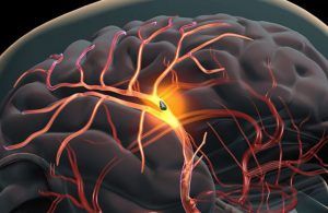 accident vascular cerebral (AVC)