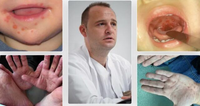 Boala Care Le Dă Fiori Părinților Semne și Simptome 4953