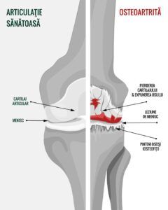 Osteoartrita reprezintă o afecțiune articulară degenerativă