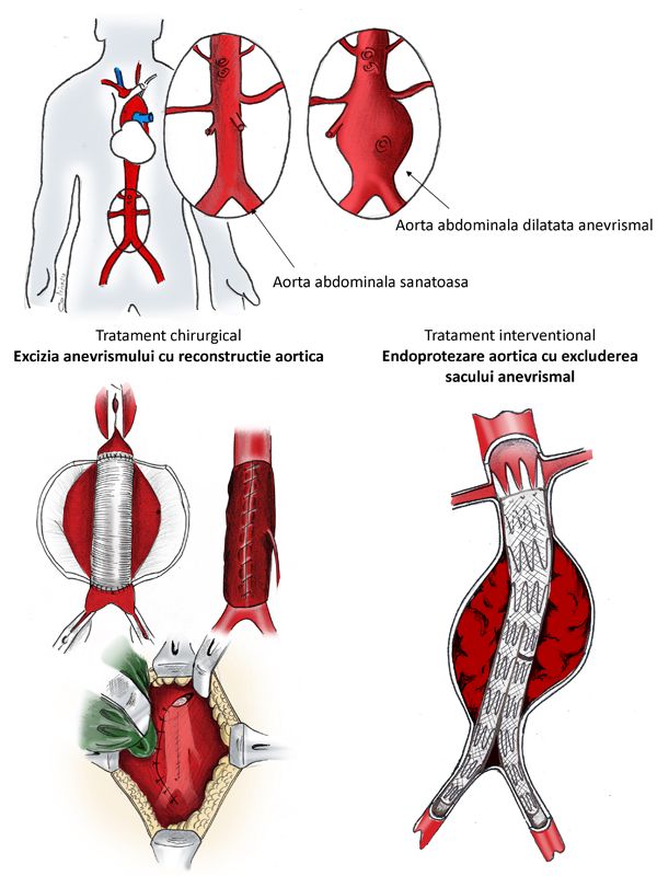 anevrism aortic